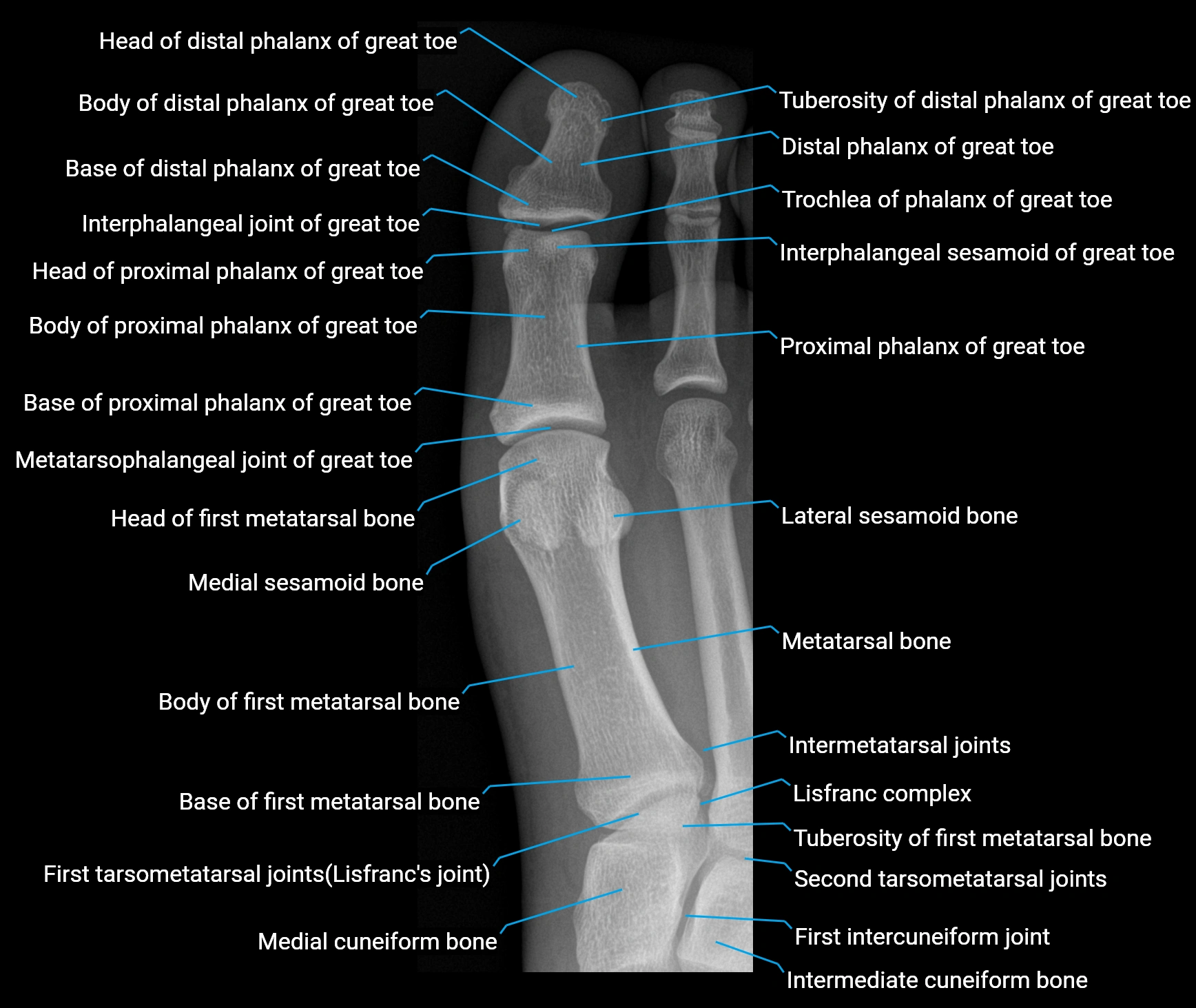 X Ray great toe PA anatomy labelled image.webp